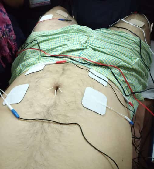 TENS therapy treatment